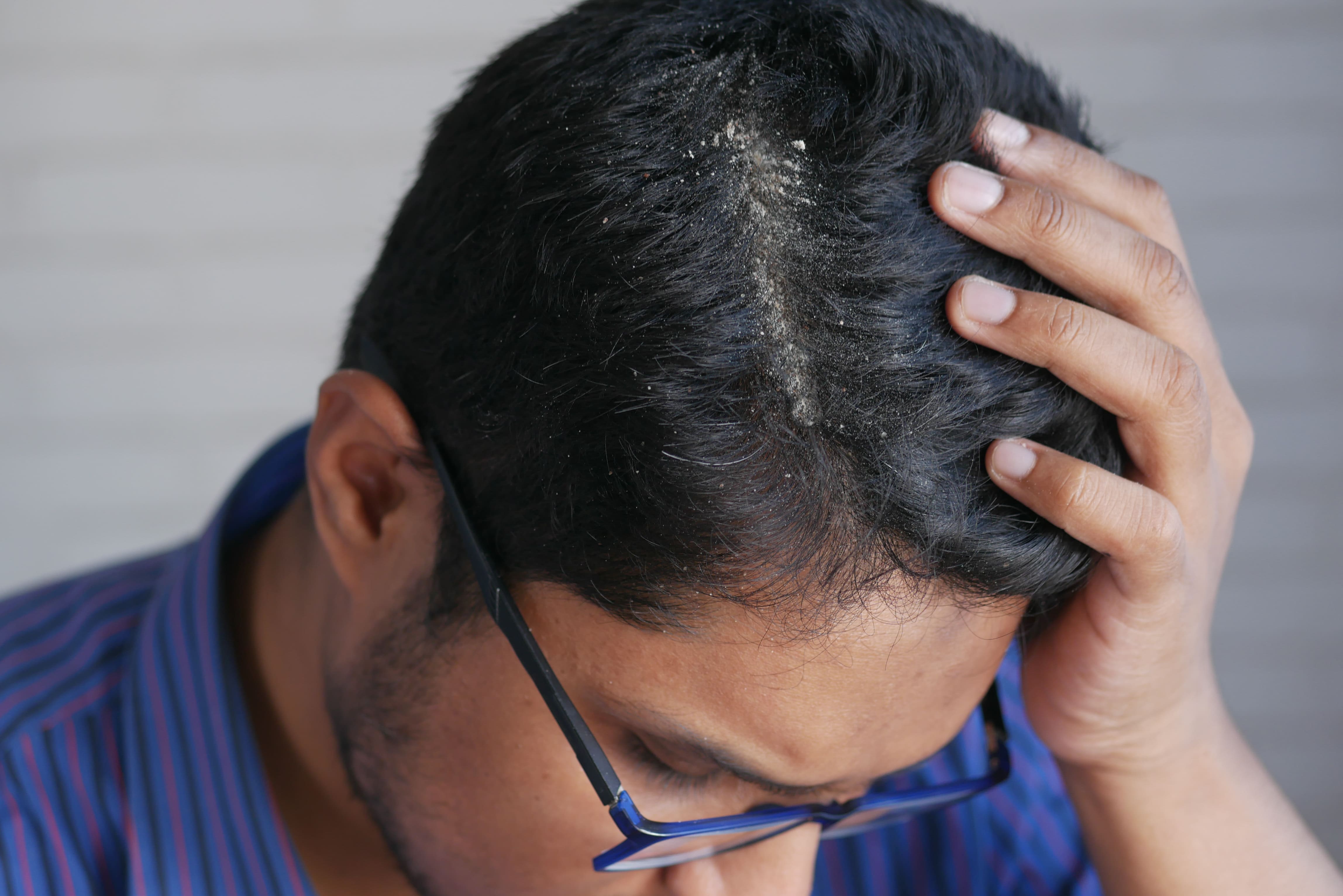 Hair & Scalp Conditions We Provide Support For